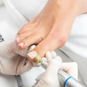 Medicinska pedikura - brušenje obnohtnih kanalov