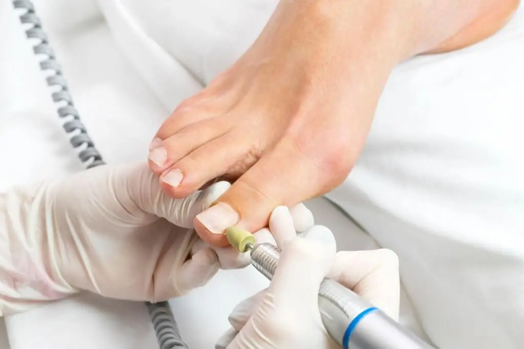 Medicinska pedikura - brušenje obnohtnih kanalov