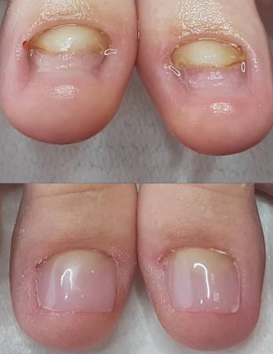 Nohtna protetika obeh palcev na nogi