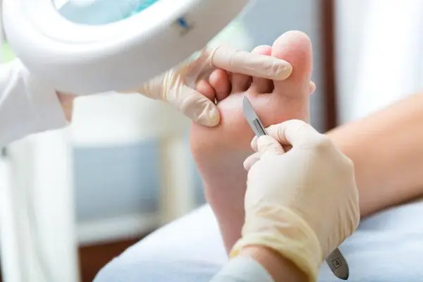 Medicinska pedikura - odstranjevanje kurjega očesa s skalpelom