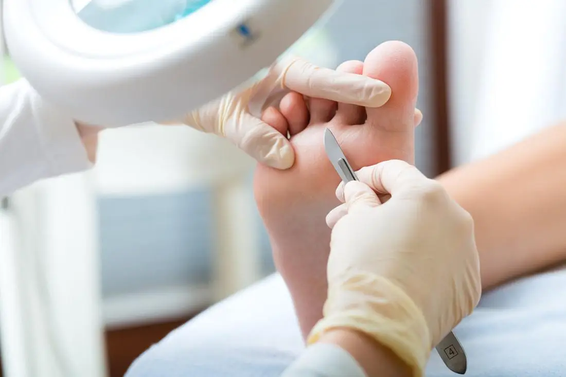 Medicinska pedikura - odstranjevanje kurjega očesa s skalpelom