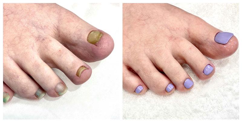 Nohtna protetika z barvnim lakom