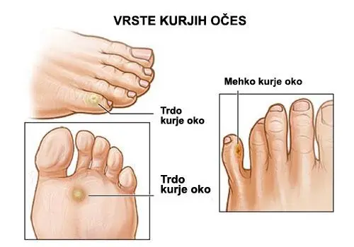 Vrste kurjih očes