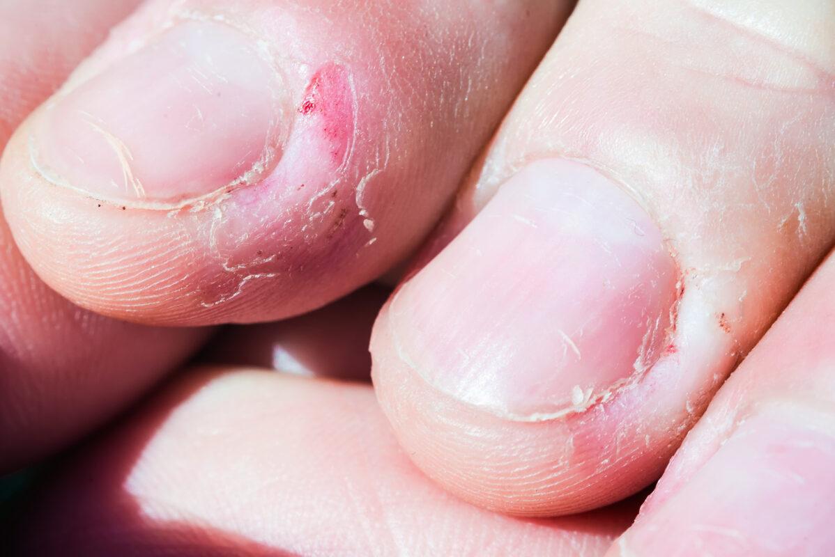 Medicinska manikura pogrižena koža