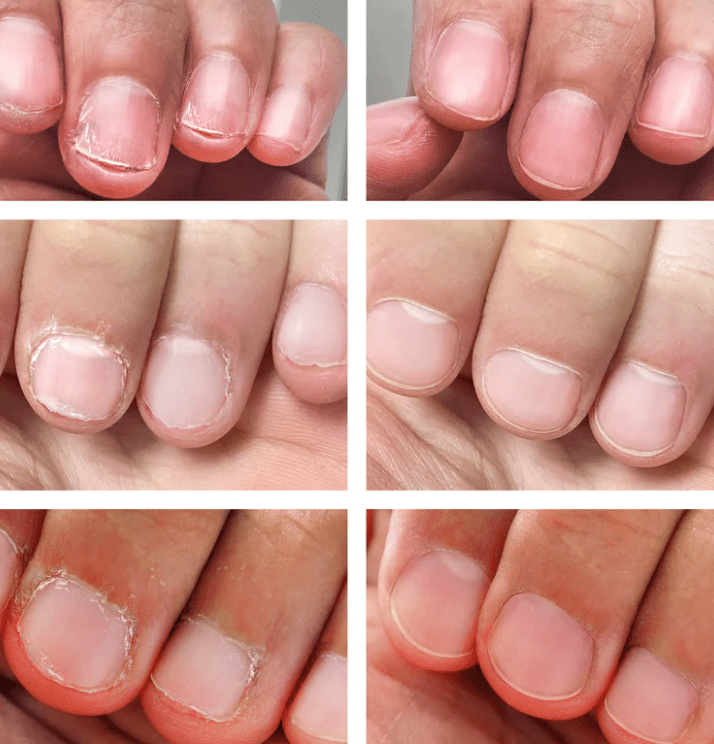 Medicinska pedikura na rokah rešitev za nohte