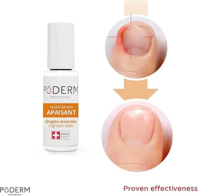PODERM Serum vraščenih nohtov prej potem