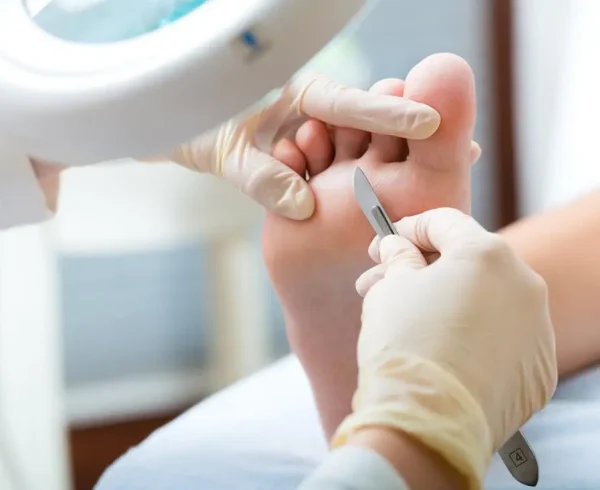 Medicinska pedikura - odstranjevanje kurjega očesa s skalpelom